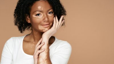 Young,Woman,Demonstrates,Her,Skin,Spots,On,Her,Hands,And